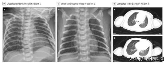 母婴传播冠状病毒,母婴传播新冠