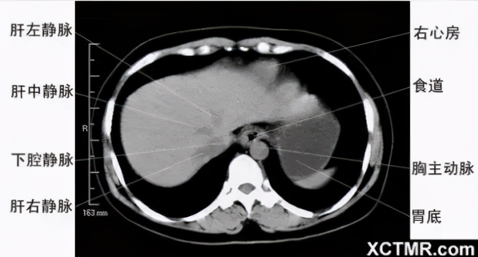 女性盆腔ct断层解剖结构图,女性盆腔脏器ct解剖