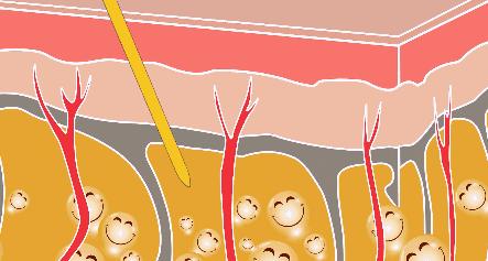 吸脂手术的优缺点,吸脂手术的副作用和危害