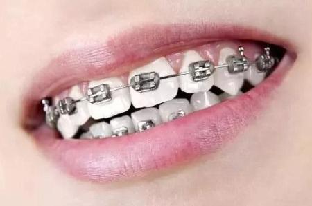 牙齿矫正打骨钉后注意事项,牙齿矫正取下牙套需要注意什么