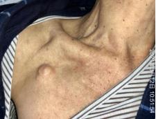 输液港皮肤过敏的处理,输液港输液有肿胀怎么处理