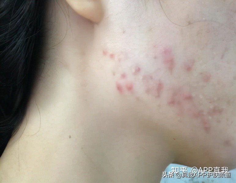 皮肤刷酸到底是什么意思,皮肤刷酸多久一次比较好