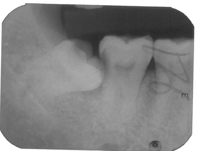 拔除智齿有什么副作用吗,拔除智齿脸会小吗还是下垂