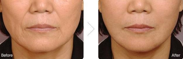 30岁下颌缘提升还有用吗,30岁下巴后缩能矫正吗