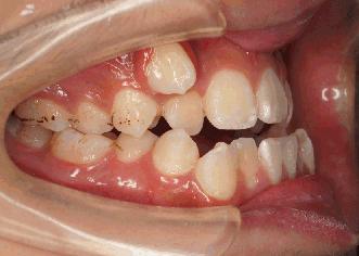 牙齿矫正黑幕素材,牙齿正畸内幕