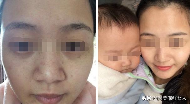 祛斑真实案例内调,祛斑案例说说