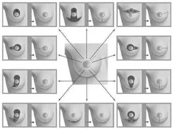 若有专家还在用这种方式治疗乳腺癌，不要犹豫，立马举报他