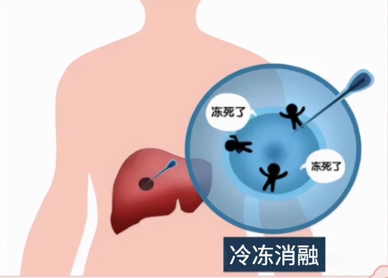 肿瘤介入微创疗法要多少钱,微创治疗肿瘤有哪些手段