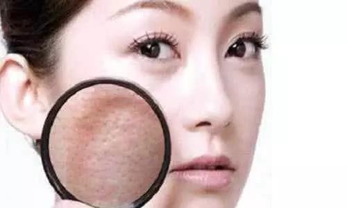 为什么痘痘好了后毛孔会变大,毛孔粗大痘印痘坑是怎么引起