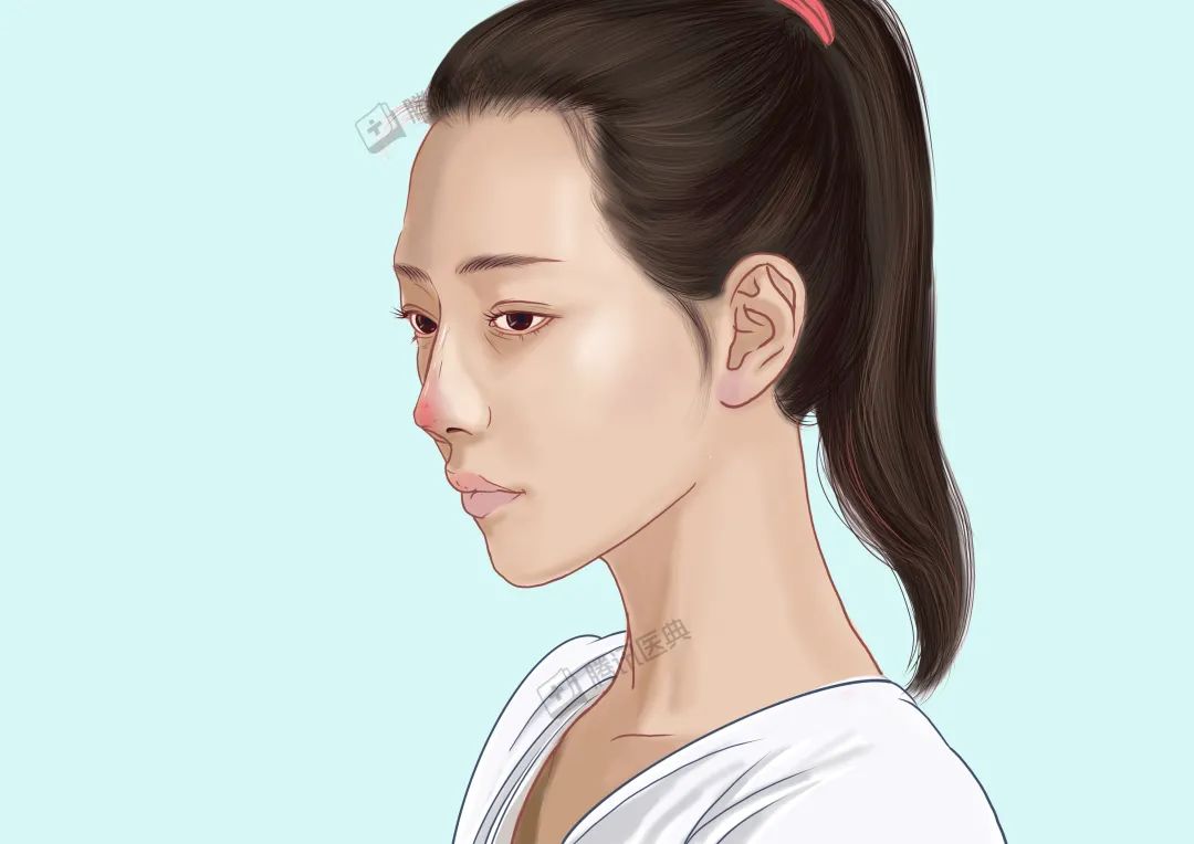 隆鼻的几大风险,隆鼻真的10个做9个后悔吗