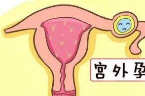 怀孕40天如何排除宫外孕,怀孕40天小肚子下坠是宫外孕吗