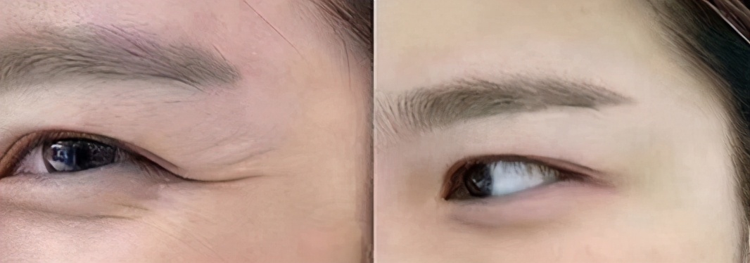 面部松弛下垂的最好解决办法,面部松弛下垂的最快恢复办法