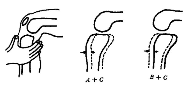 膝关节x线片可以查出啥,膝关节间隙x线测量方法
