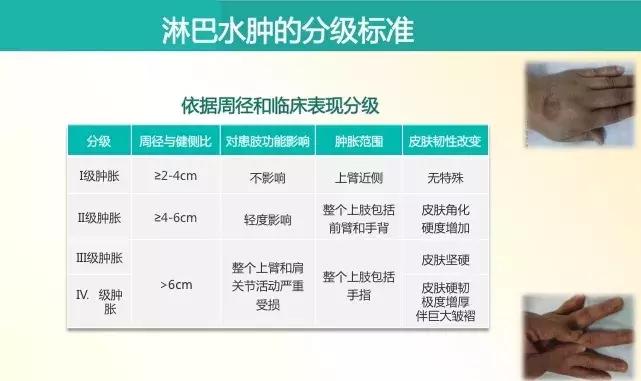 乳腺癌放疗水肿怎样解决,乳腺癌放疗后出现水肿怎么办