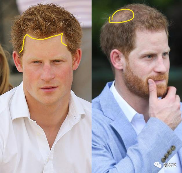 威廉王子秃顶了哈里为啥没秃顶,威廉王子为什么喜欢秃顶