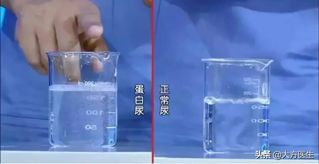 尿常规检查10项解读,尿常规10项尿潜血