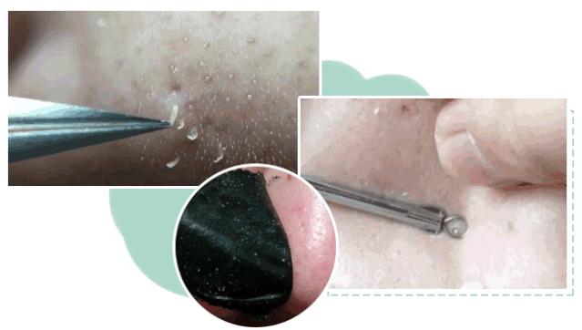 黑头除了用鼻贴还能怎么做,去黑头用洗面奶好还是黑头贴好