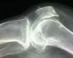 长骨刺用什么方法治疗最好,腰椎长骨刺最好的治疗方法