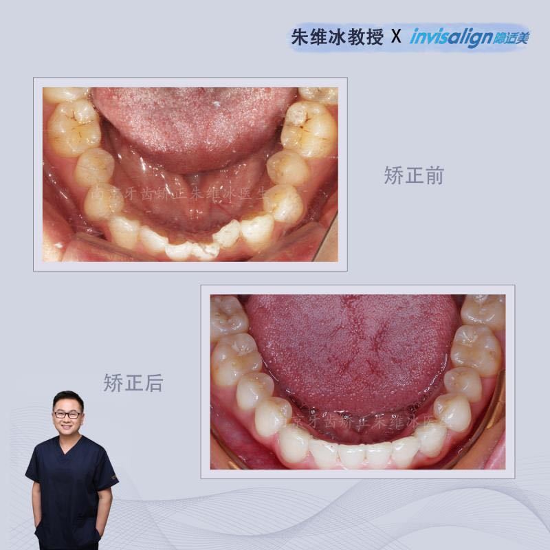 牙齿重度拥挤不拔牙正畸成功案例,南京牙齿矫正舌侧