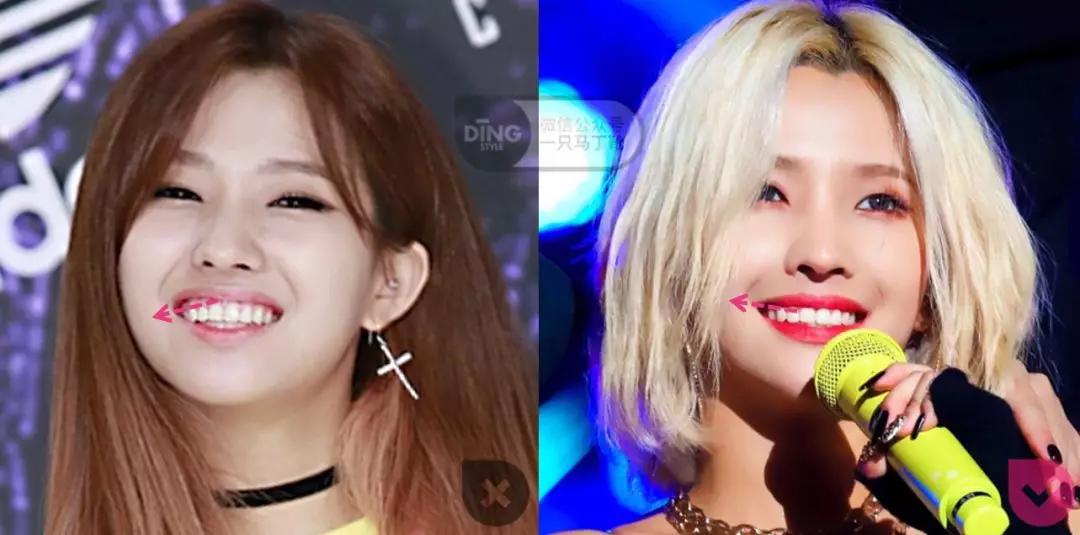 戴牙套凸嘴怎么化妆,凸嘴整牙削骨吗