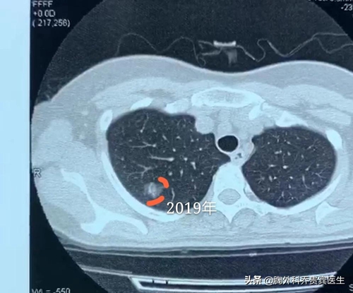 50岁女性结节,女人50以后查出来有结节怎么治疗