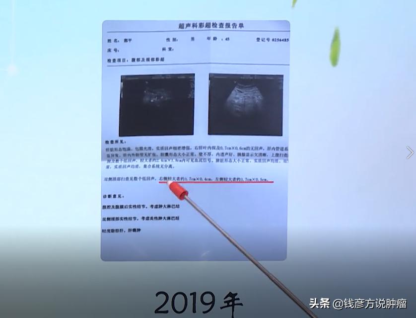 惰性淋巴瘤可以切除吗,惰性淋巴瘤化疗效果如何