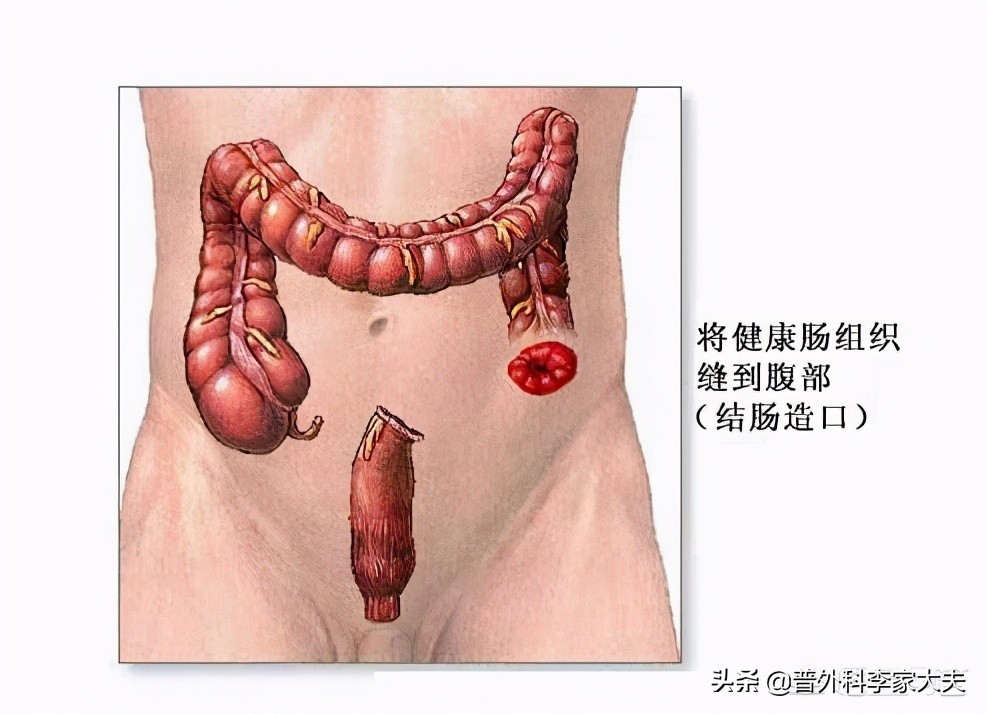 肠癌体质风险因素，来讨论直肠该如何保肛？