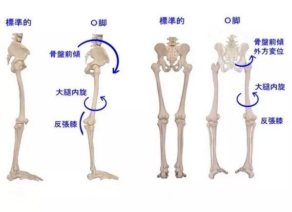 练就笔直大长腿，OX腿型如何应对？！｜运动康复003课
