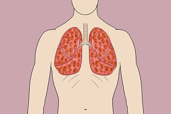 白天不咳嗽，晚上却咳得很厉害，是什么原因？医生帮你揪出祸首