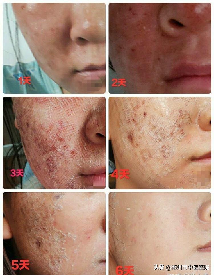 二氧化碳激光点阵掉痂后皮肤很干,二氧化碳点阵激光留下坑