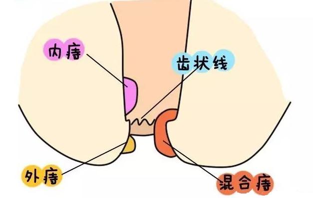 怎么判断自己有没有痔疮?医生坦言:有这5种症状,八九不离十