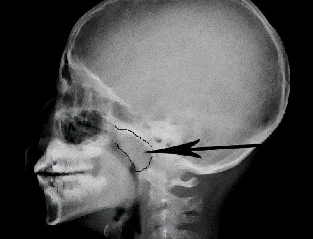 孩子打鼾别大意警惕腺样体肥大,孩子打鼾一定是腺样体肥大么