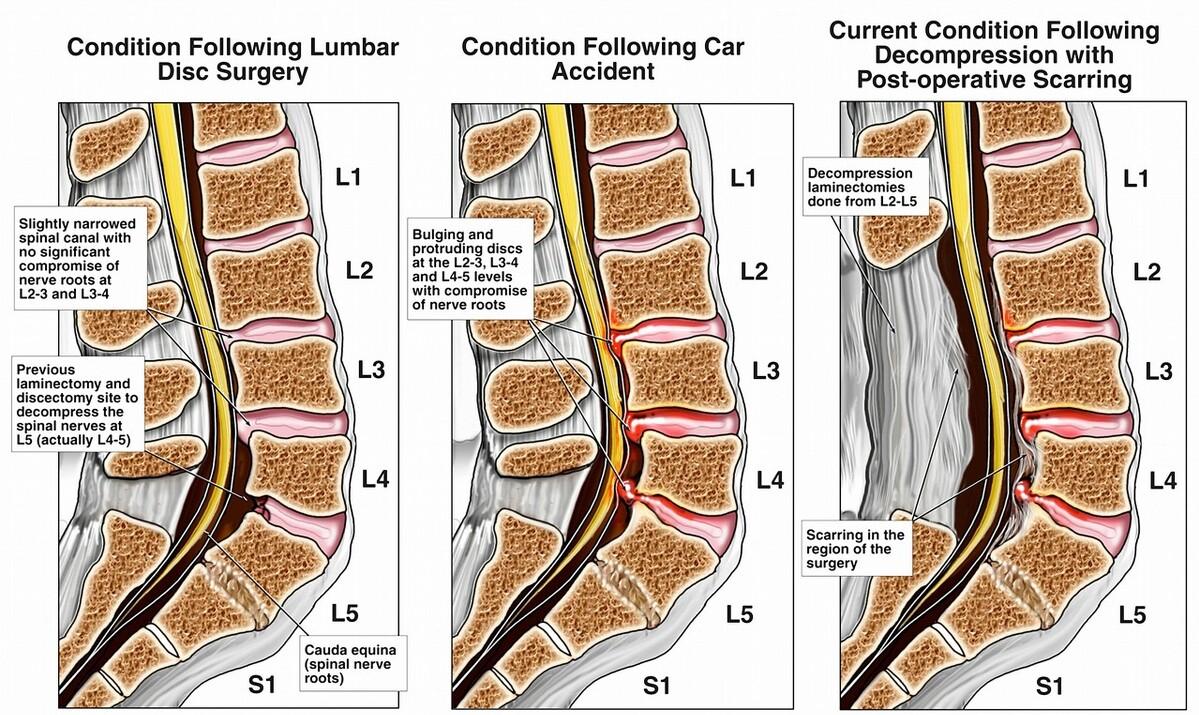 八十多岁老人腰痛直不起来,80多岁老太太腰椎疼得厉害