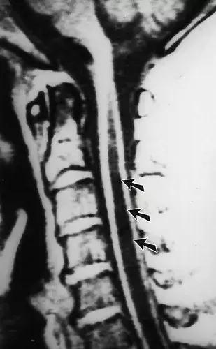 神经性骨关节病,神经性关节炎症状图片