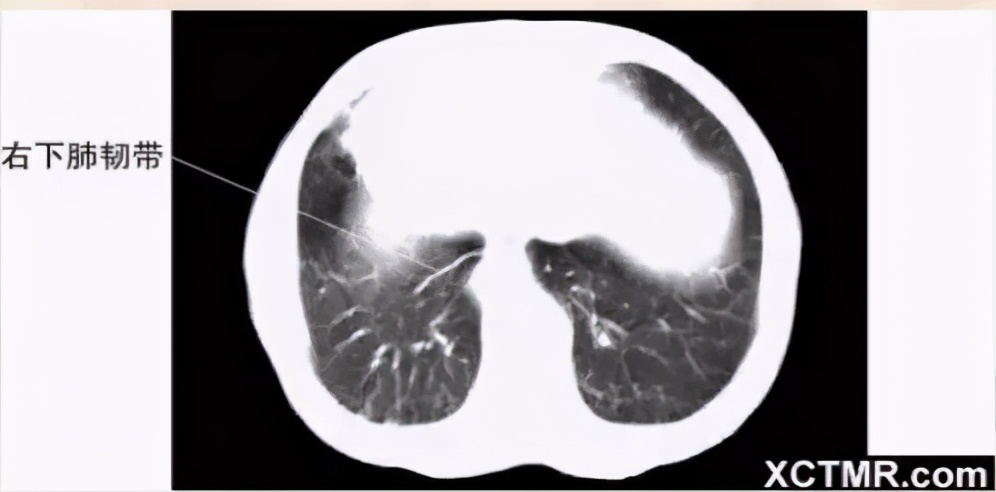 女性盆腔ct断层解剖结构图,女性盆腔脏器ct解剖