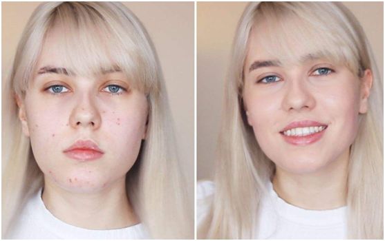 片仔癀净痘修护贴,抗痘贴片仔癀