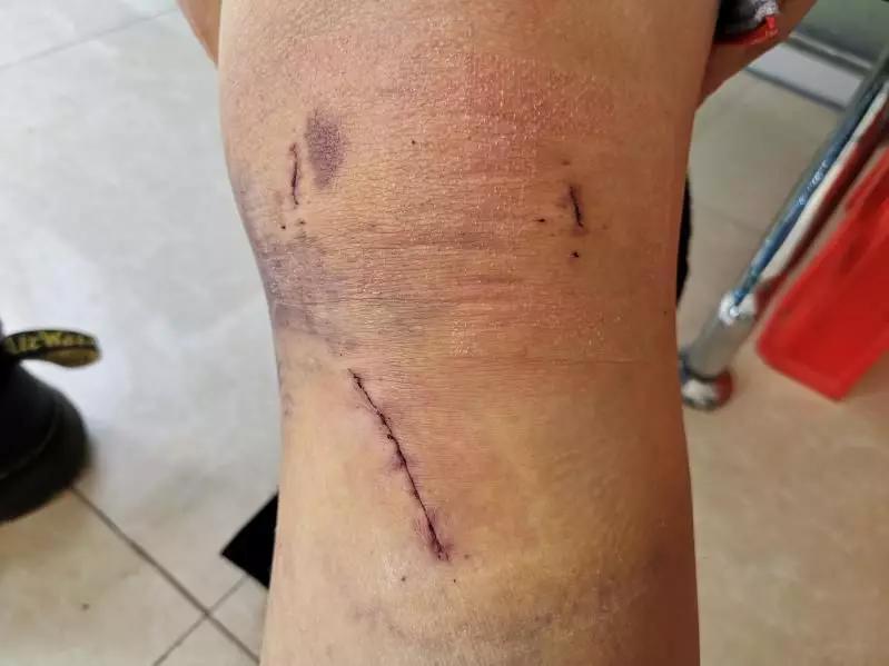 滑雪运动前叉韧带损伤康复,滑雪导致前交叉韧带断裂