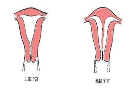 子宫畸形真实故事,子宫的故事绘本