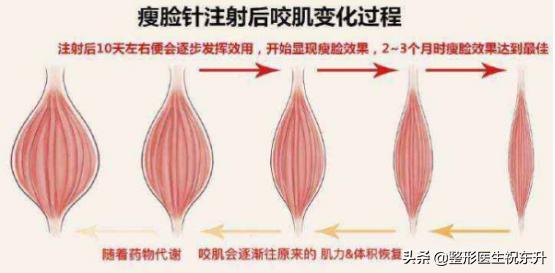 有的瘦脸针打了脸会酸有的没感觉,打完除皱针脸部看上去很奇怪