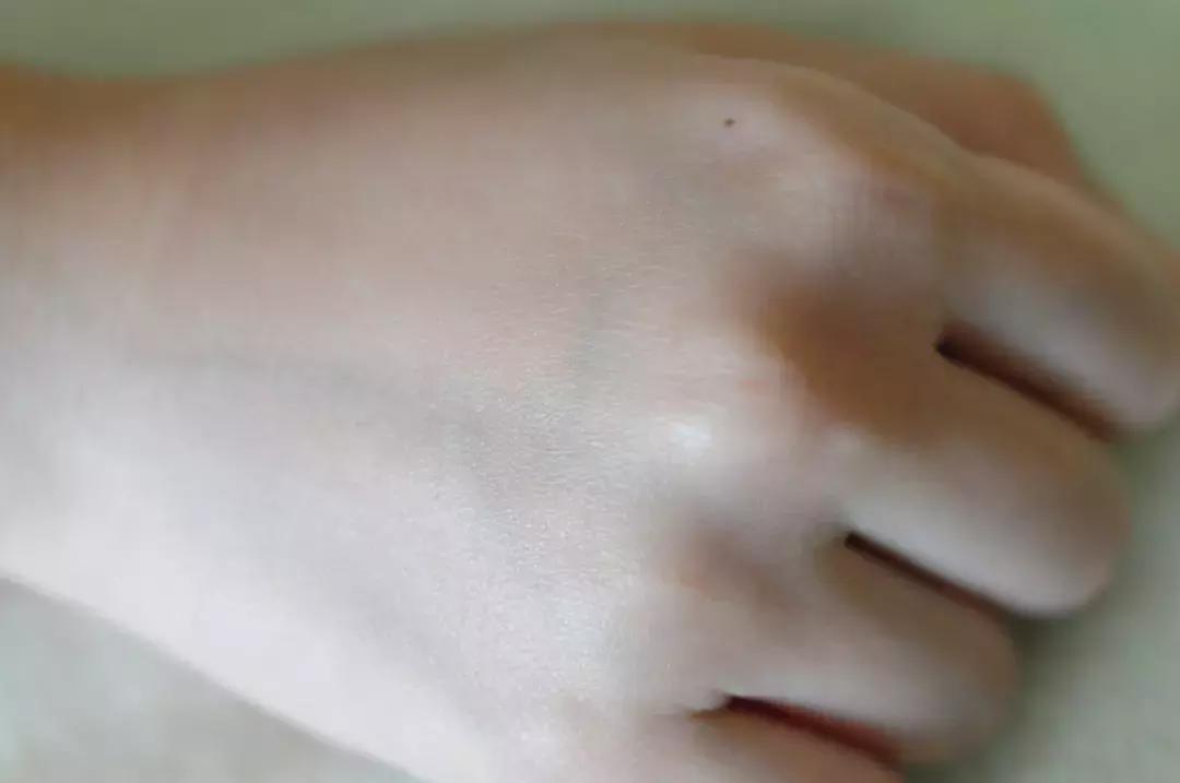 金银花对付痘痘,对付所有痘痘的药膏