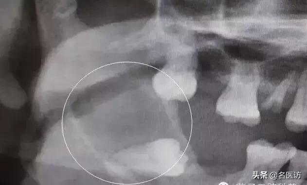 拔智齿：讳疾忌医有什么后果？