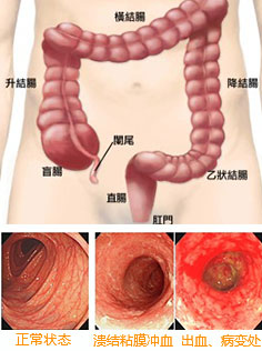 溃疡性结肠炎也会转化成癌？一旦出现这3种迹象，十有八九在癌变