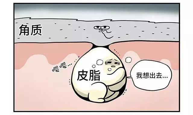 闭合性粉刺能挤干净吗,闭合性粉刺能不能挤出来