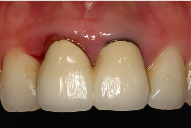 烤瓷牙破冠怎么办,基牙损坏保留烤瓷冠