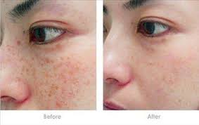 减轻面部色素沉着的10种小妙招