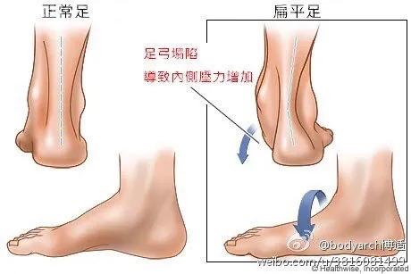 儿童足部常见问题,儿童足部运动康复训练动作大全