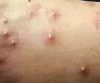 红火蚁入侵致多少人死,红火蚁伤人死亡新闻报道