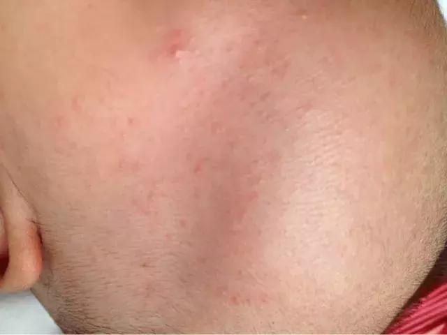 痱子粉止痒儿童,孩子起痱子用痱子粉管用吗