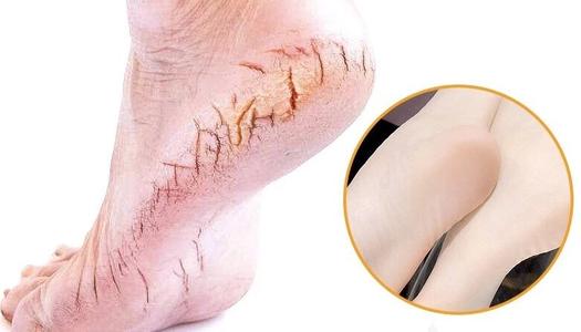 为什么汗脚特别臭,汗脚突然变干脚裂口什么原因