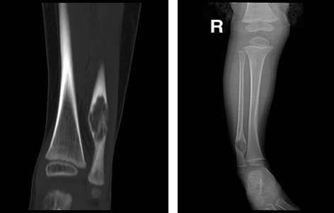 儿童骨纤维结构不良图片,8岁儿童骨纤维结构不良